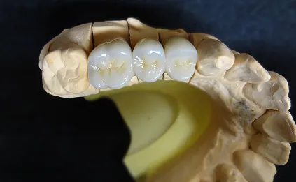 ブリッジの寿命について