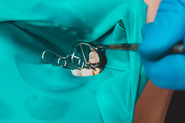 ラバーダム使用（唾液・細菌の侵入を防ぐ）