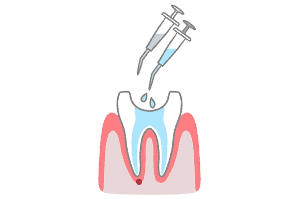 根管洗浄（次亜塩素酸、EDTAなど）
