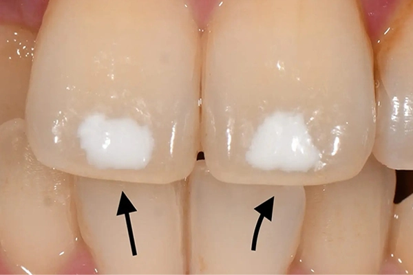 白い斑点が気になる方へ
ホワイトスポット治療